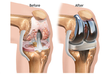 Benefits after Joint replacement Surgery