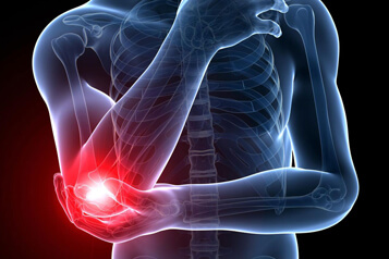 Elbow joint replacement surgery is necessary because of the following conditions